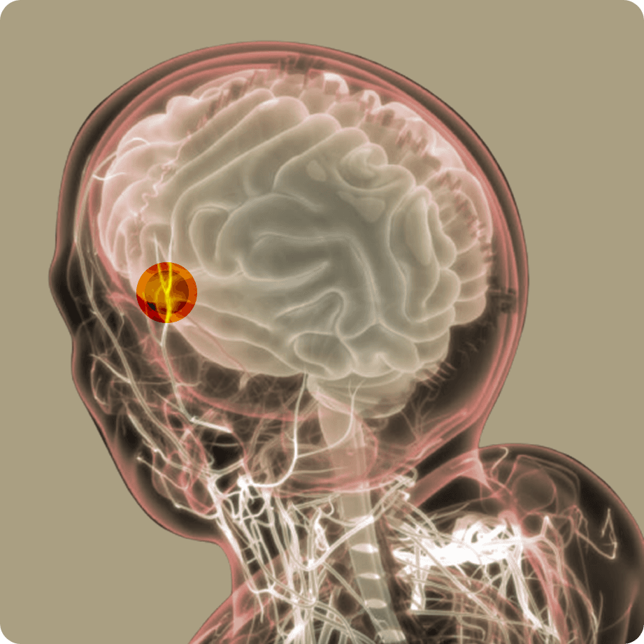 Anatomical illustration of a head in profile, the brain shown translucent with a small bright implant site glowing near the front